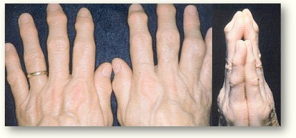 Artrosi della mano