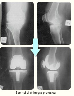 Esempi di chirurgia protesica