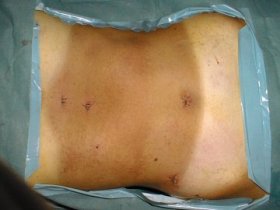 Esito di recente intervento di colecistectomia laparoscopica