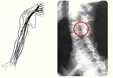 Artrosi cervicale
