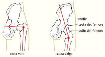 Coxa vara e coxa valga
