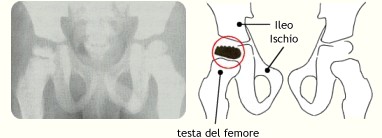 Osteocondrosi della testa femorale (malattia di Legg-Perthes-Calv)