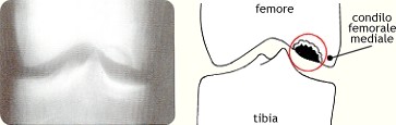 Osteocondrosi del condilo femorale (malattia di Konig)