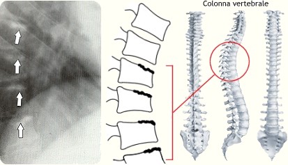 Osteocondrosi vertebrale giovanile (malattia di Scheuermann)