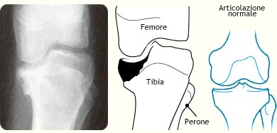 Tibia vara (malattia di Blount)